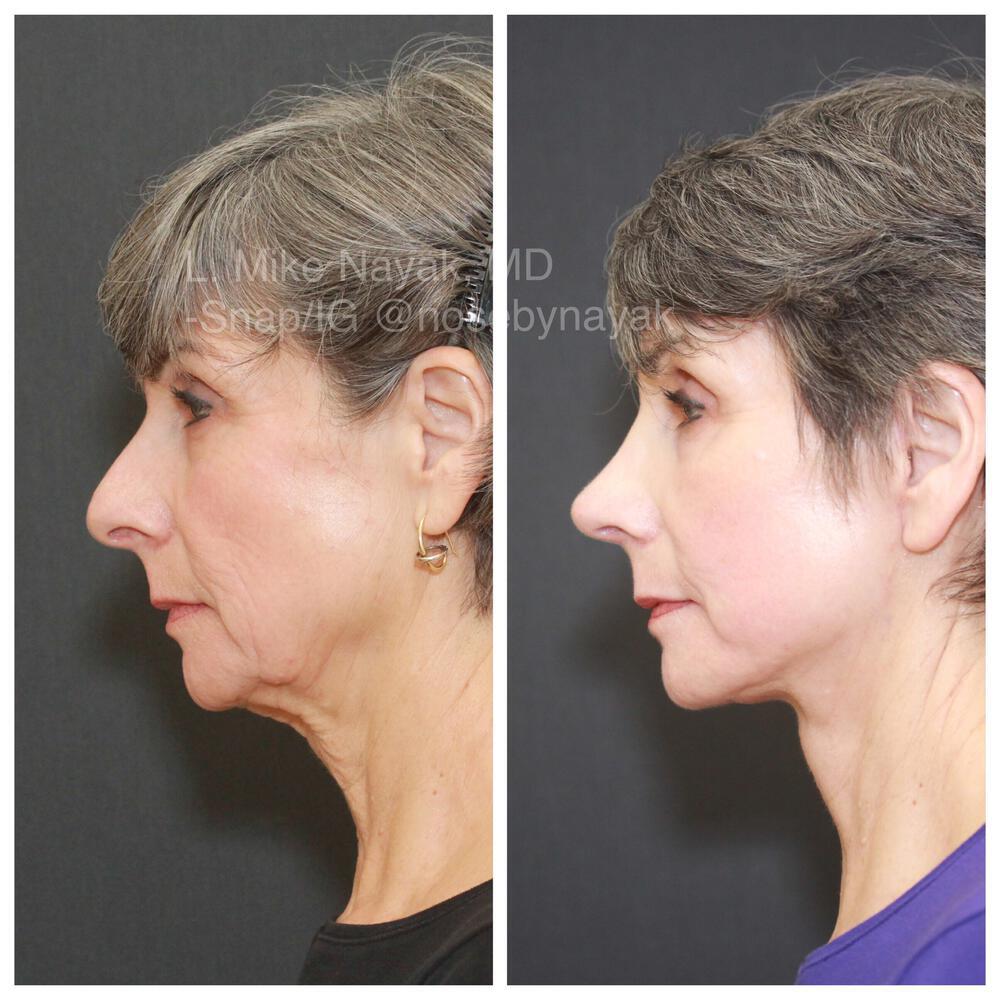 Facelift and Neck Before & After Image