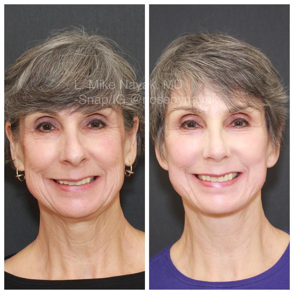 Facelift and Neck Before & After Image