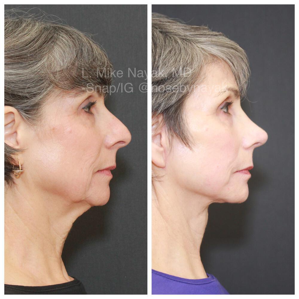 Facelift and Neck Before & After Image