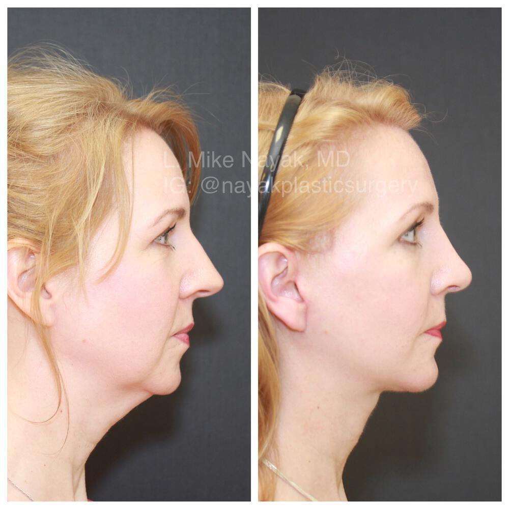 Facelift and Neck Before & After Image