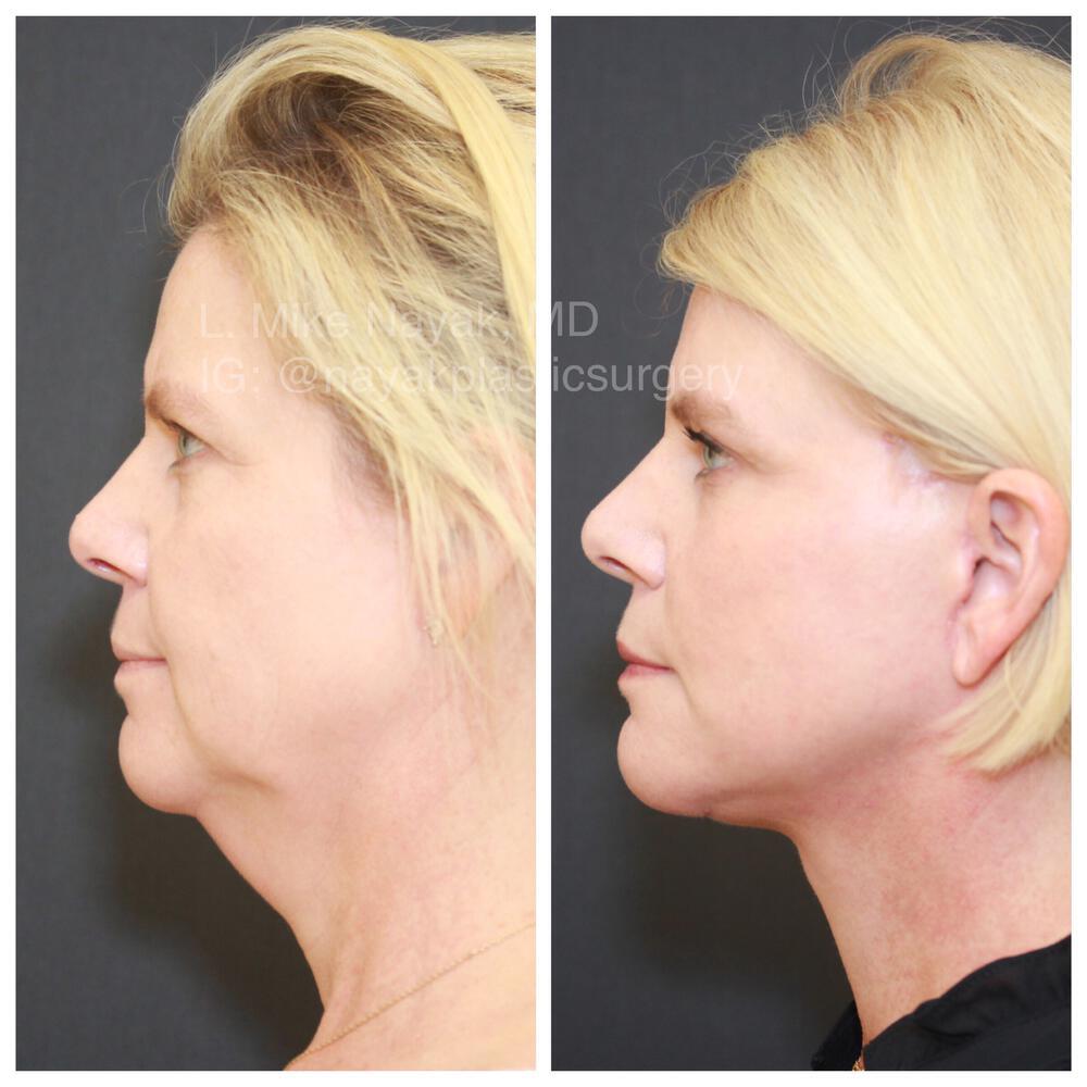 Facelift and Neck Before & After Image