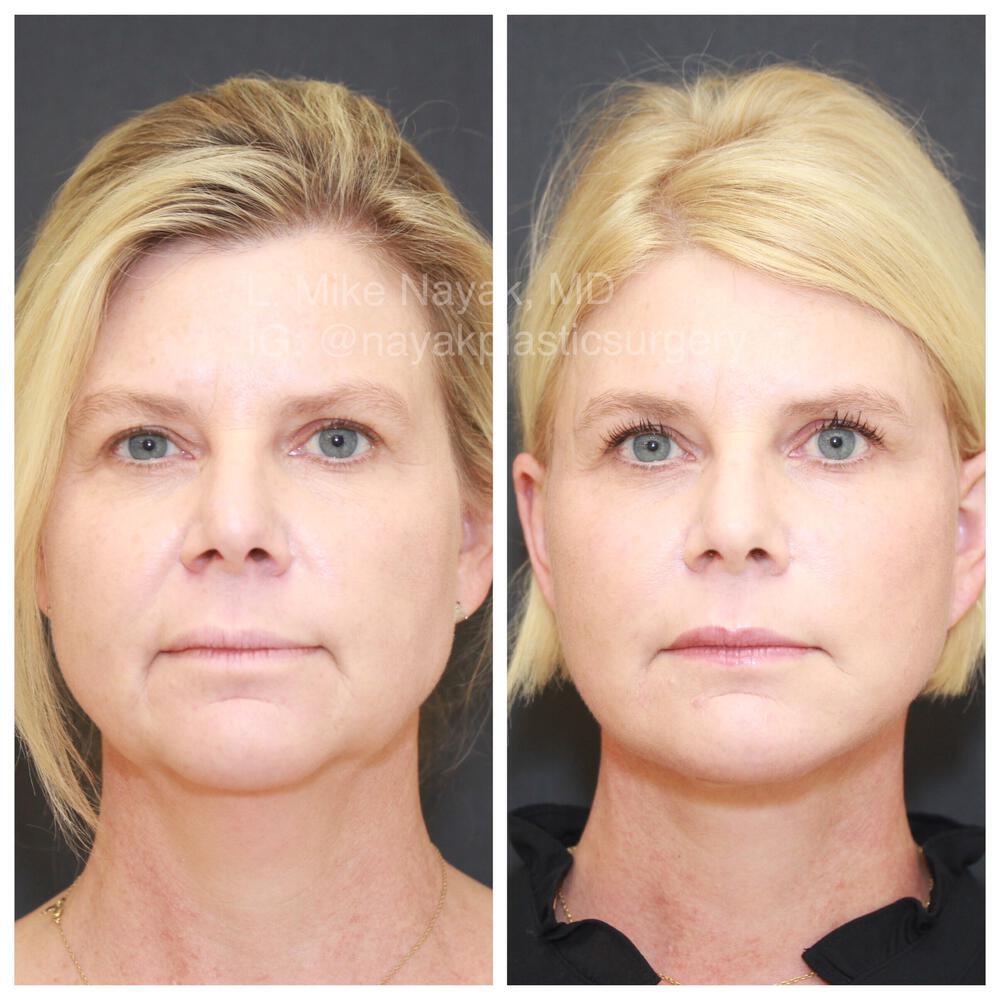 Facelift and Neck Before & After Image