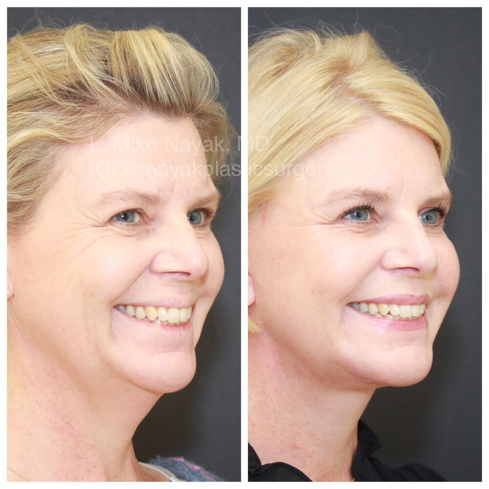 Facelift and Neck Before & After Image