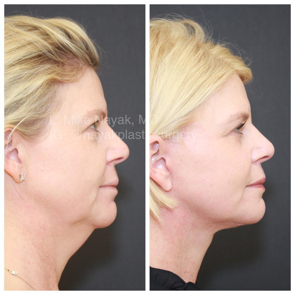 Facelift and Neck Before & After Image