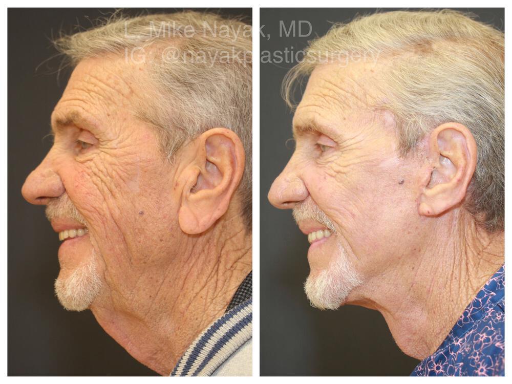 Facelift and Neck Before & After Image