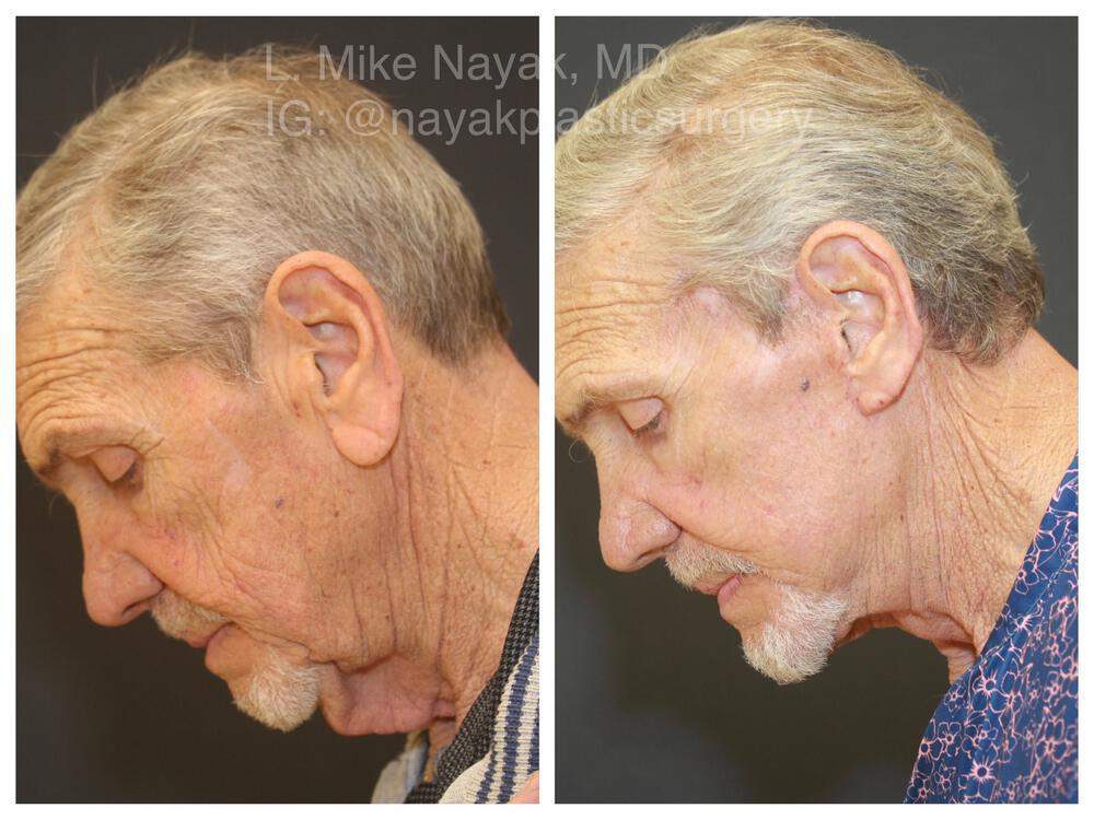 Facelift and Neck Before & After Image