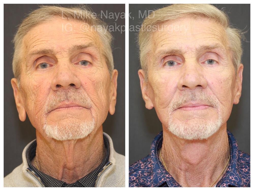 Facelift and Neck Before & After Image