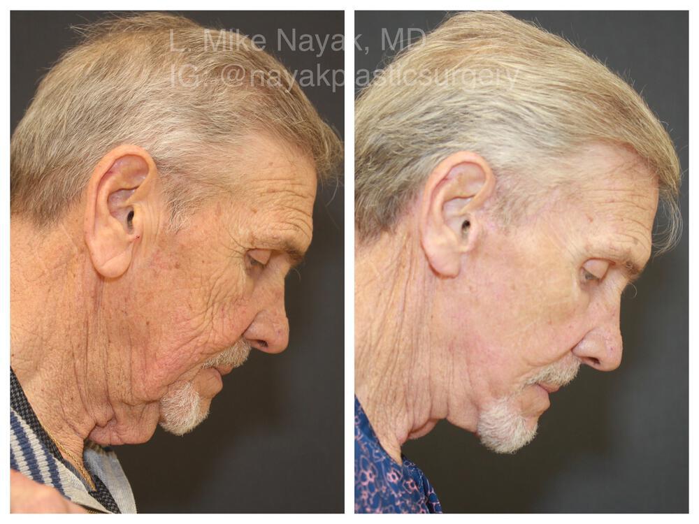 Facelift and Neck Before & After Image