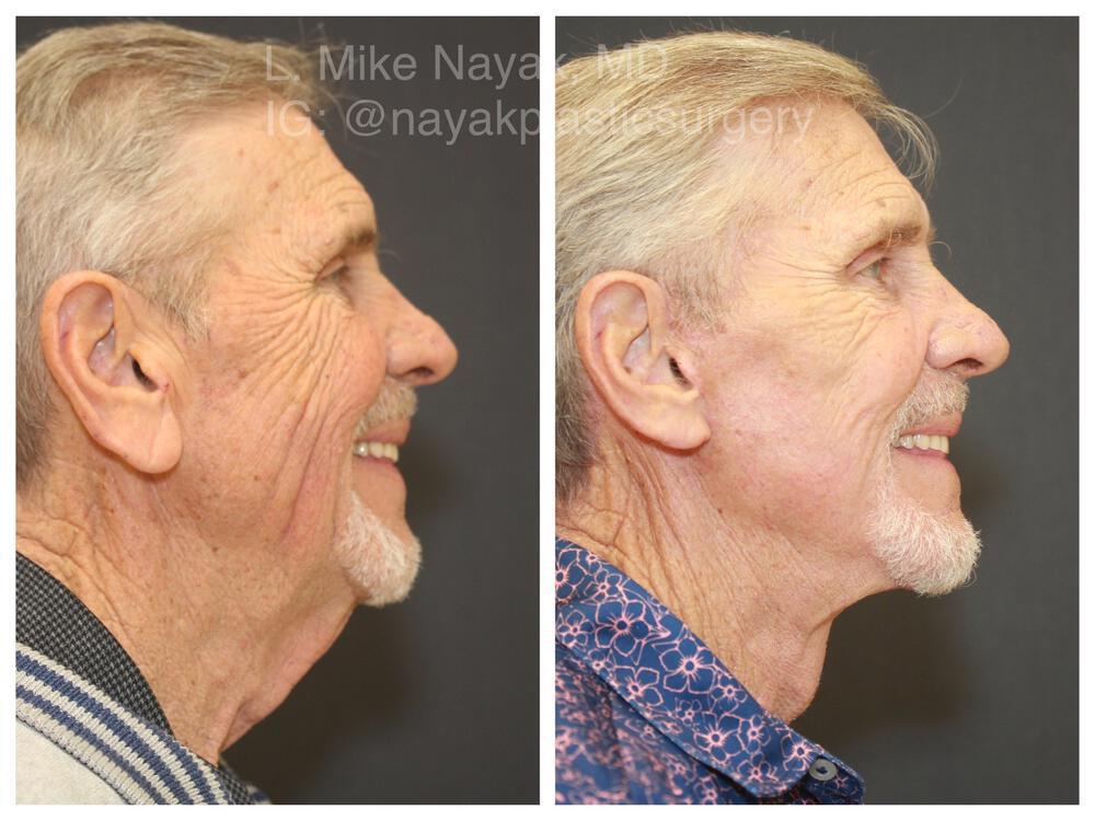 Facelift and Neck Before & After Image