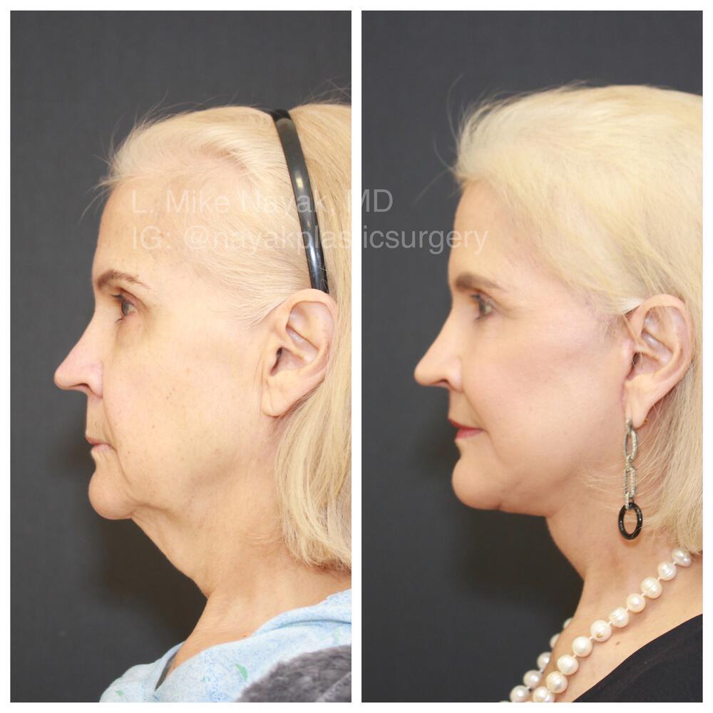 Facelift and Neck Before & After Image