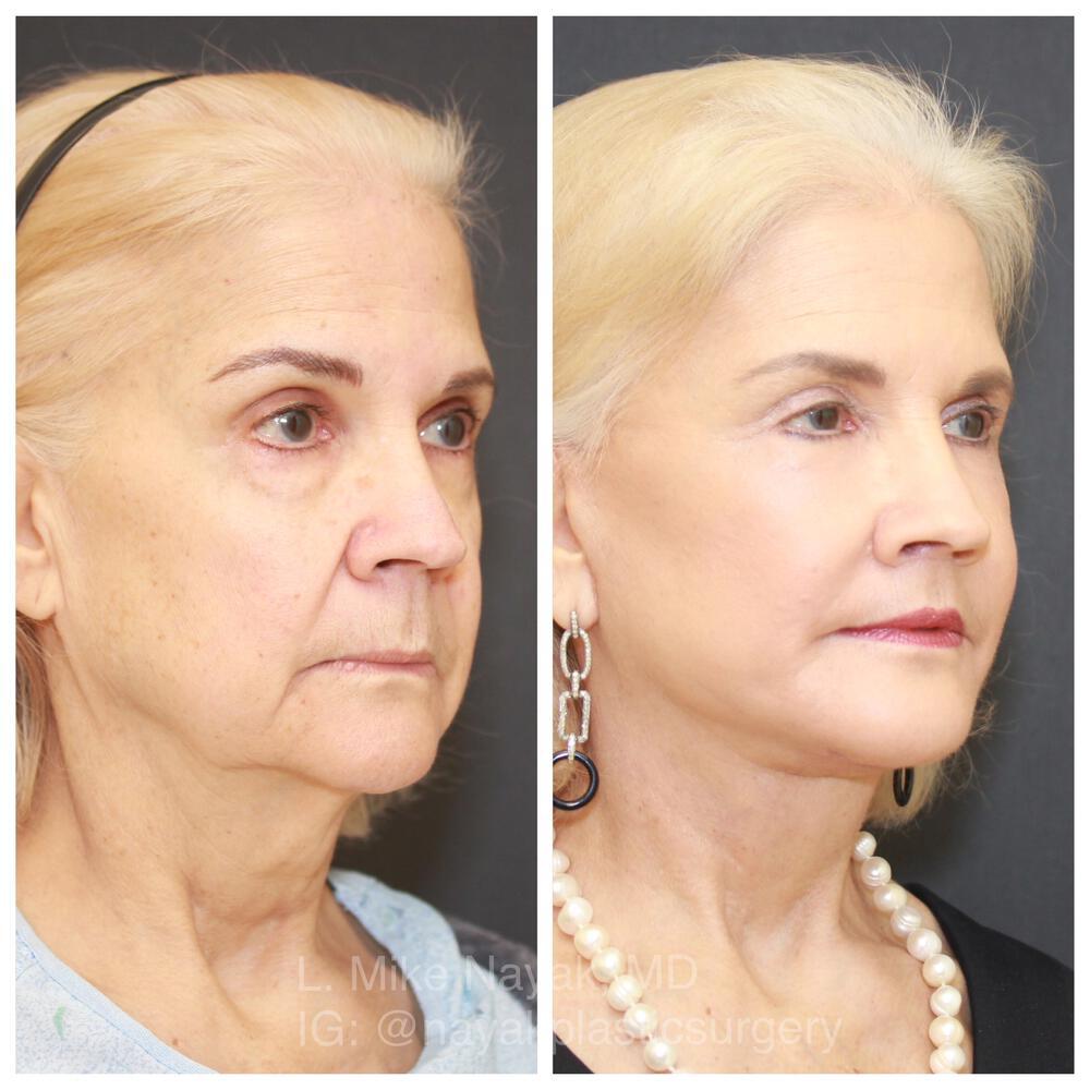 Facelift and Neck Before & After Image