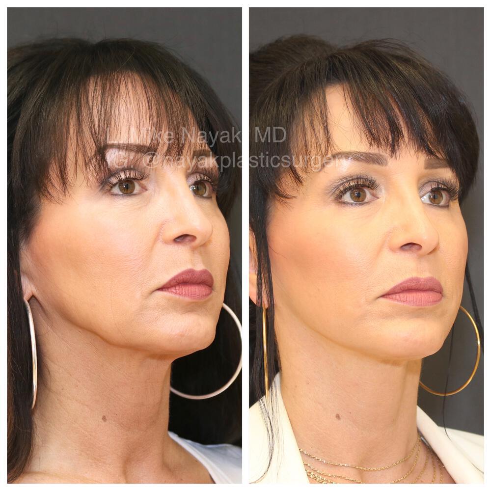 Facelift and Neck Before & After Image