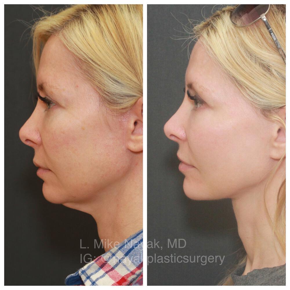 Facelift and Neck Before & After Image