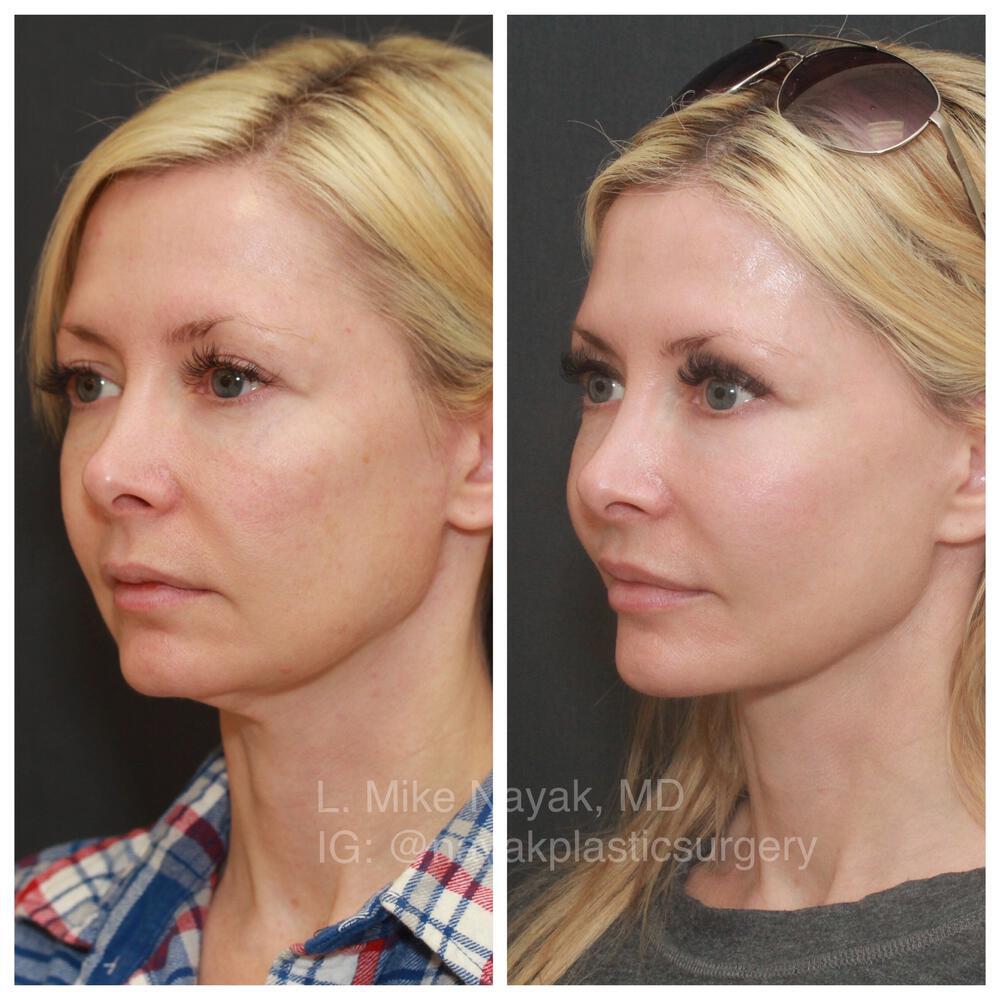 Facelift and Neck Before & After Image