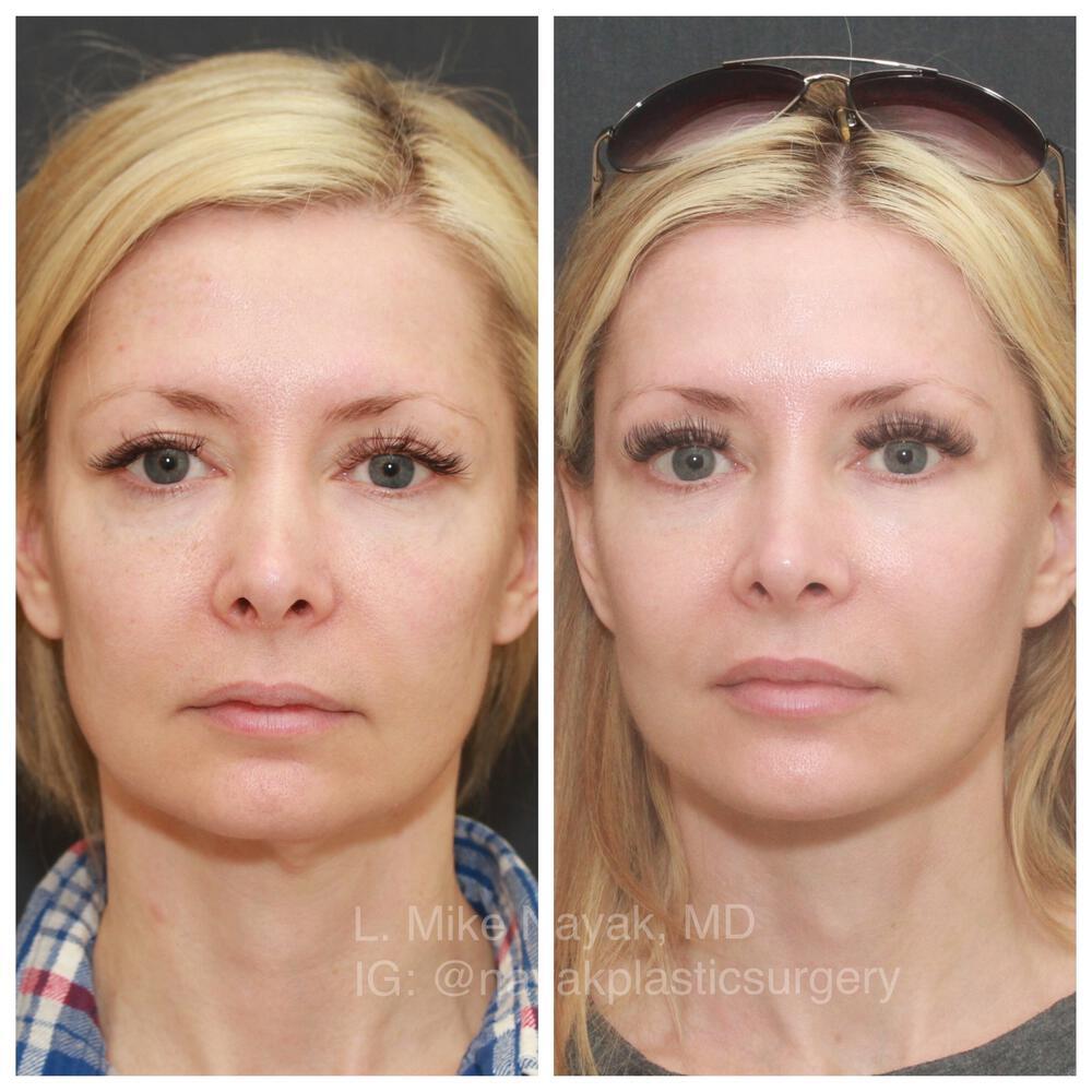 Facelift and Neck Before & After Image