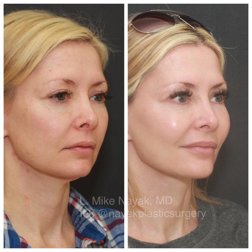 Facelift and Neck Before & After Image