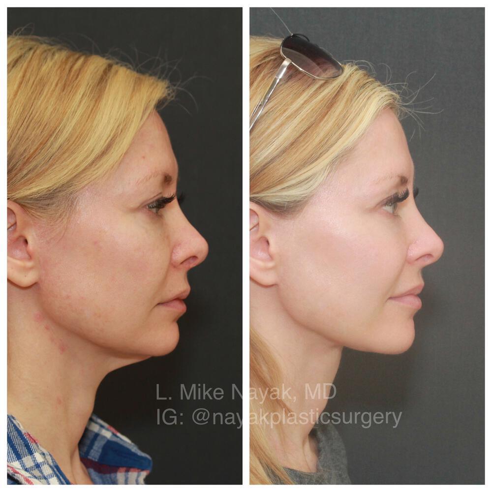 Facelift and Neck Before & After Image