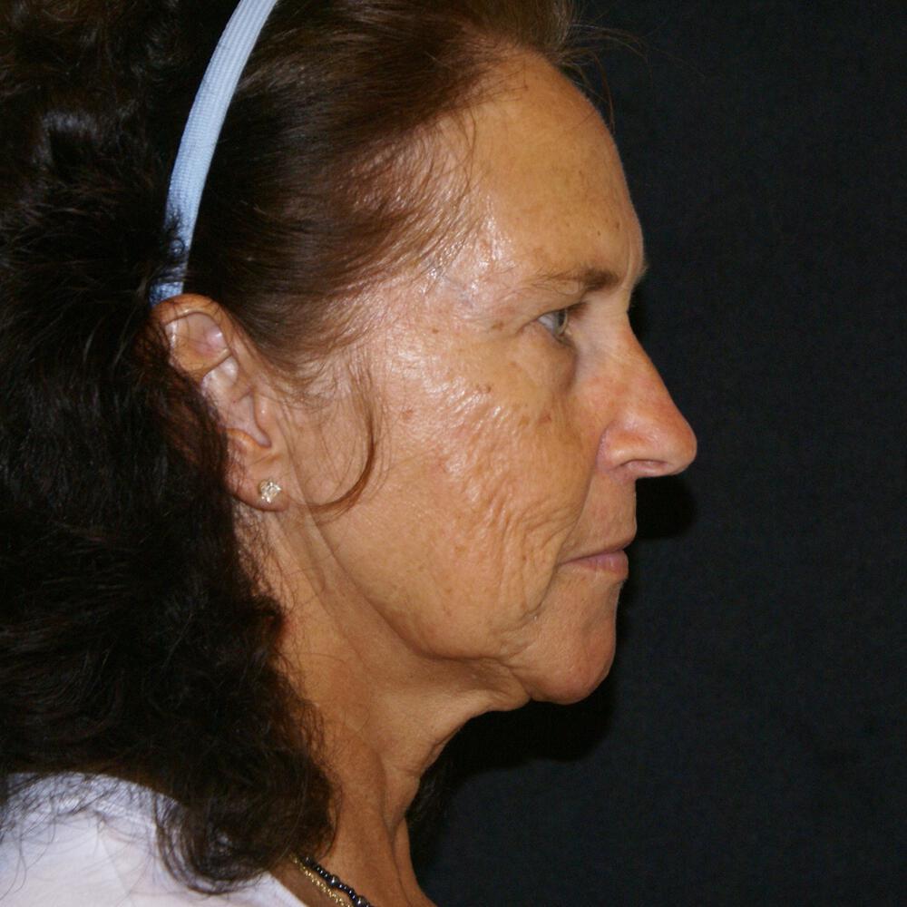 Facelift and Neck Before & After Image