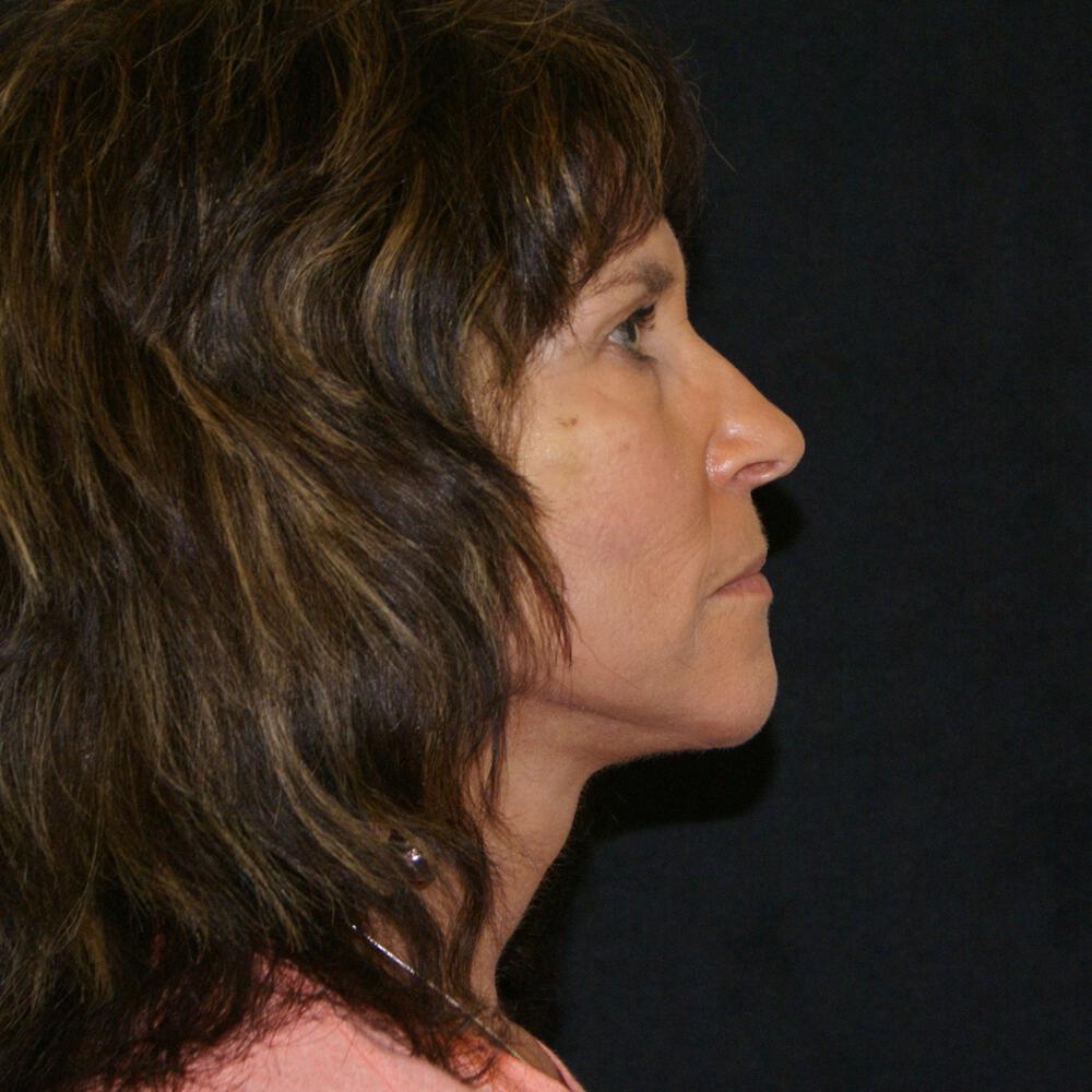 Facelift and Neck Before & After Image