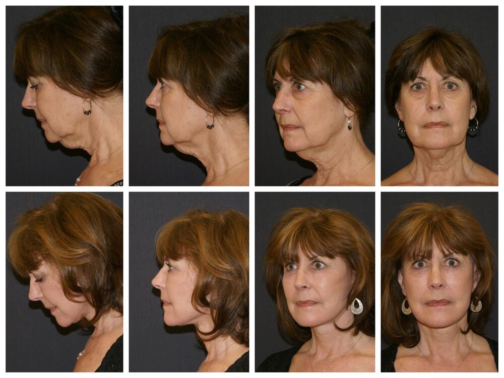 Facelift and Neck Before & After Image