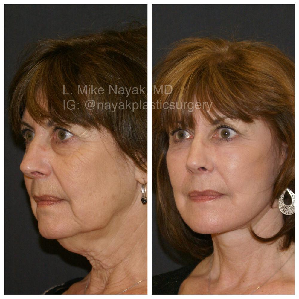 Facelift and Neck Before & After Image