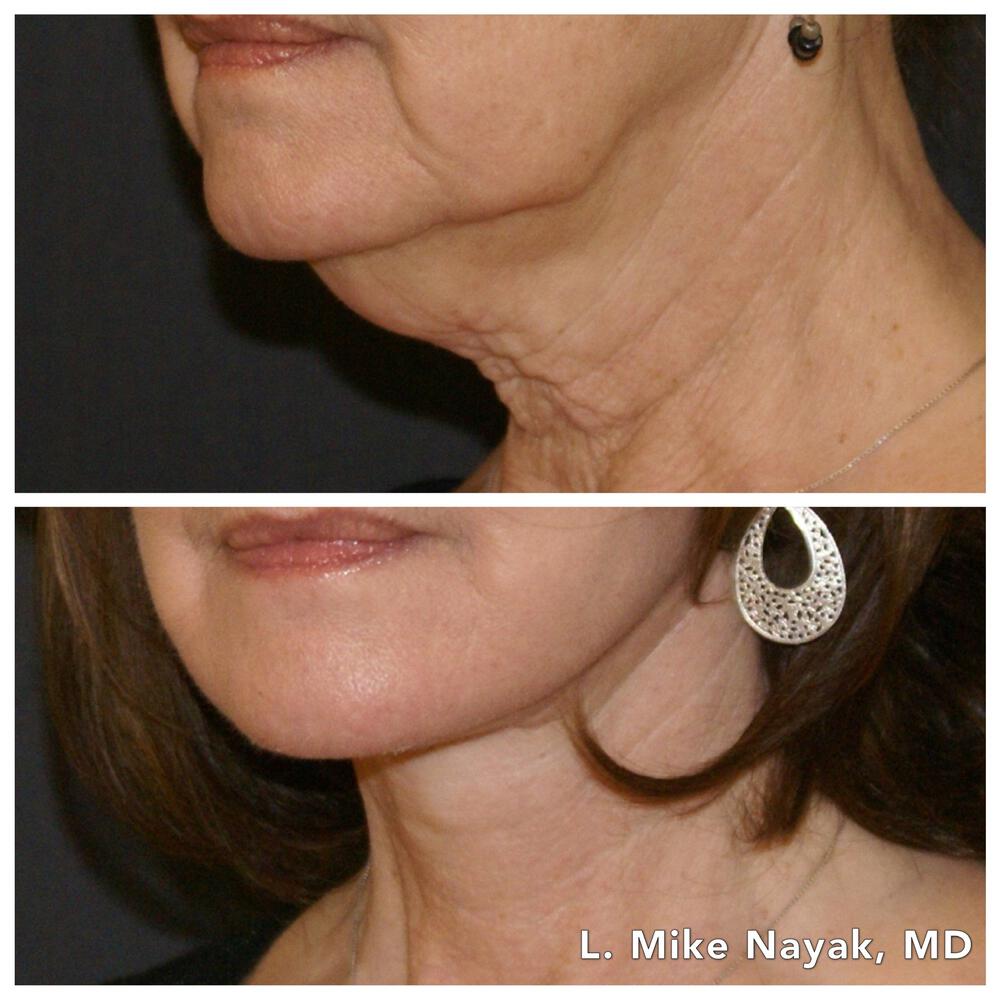 Facelift and Neck Before & After Image