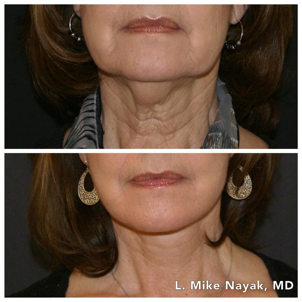 Facelift and Neck Before & After Image