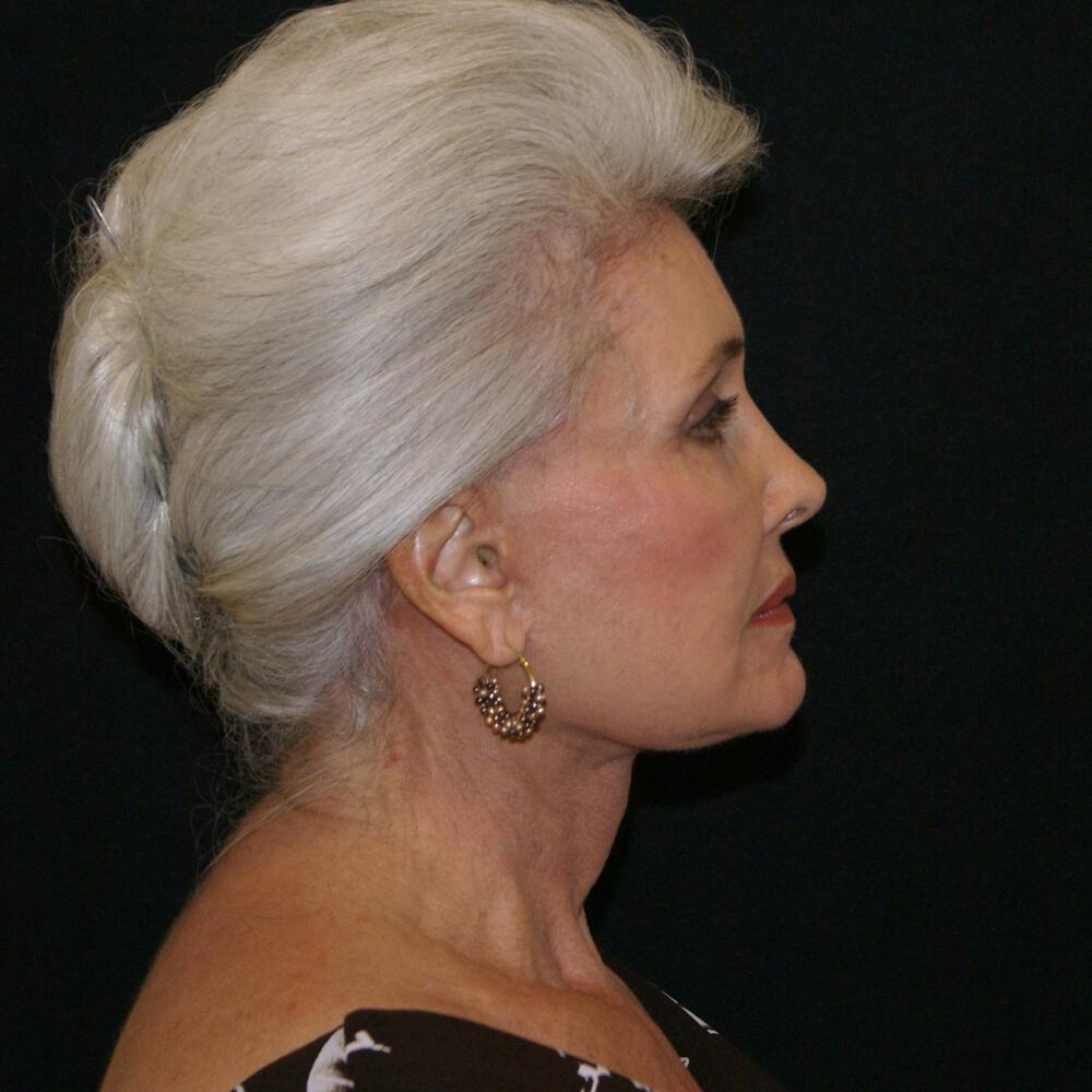 Facelift and Neck Before & After Image