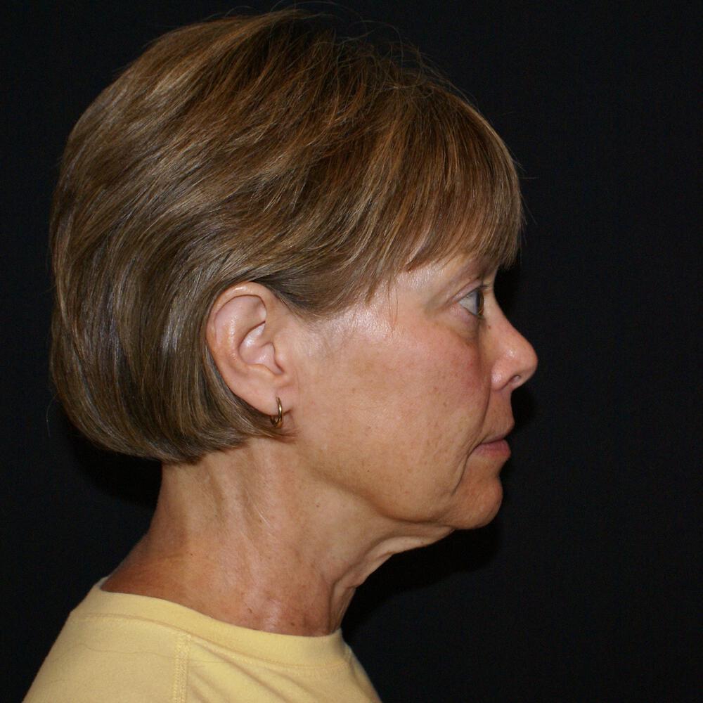 Facelift and Neck Before & After Image