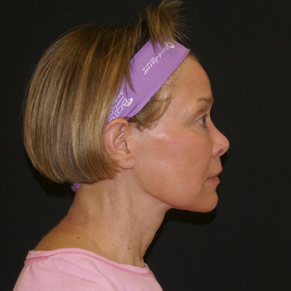 Facelift and Neck Before & After Image