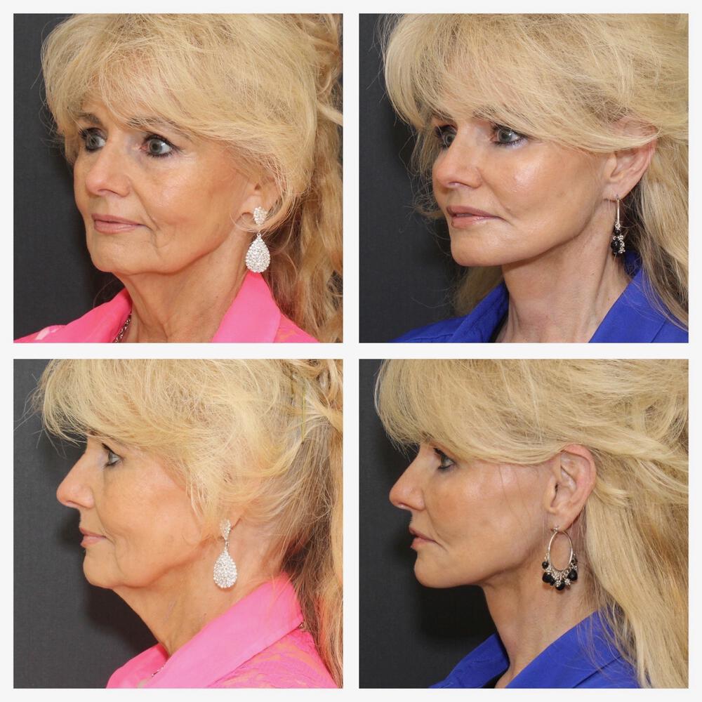 Facelift and Neck Before & After Image