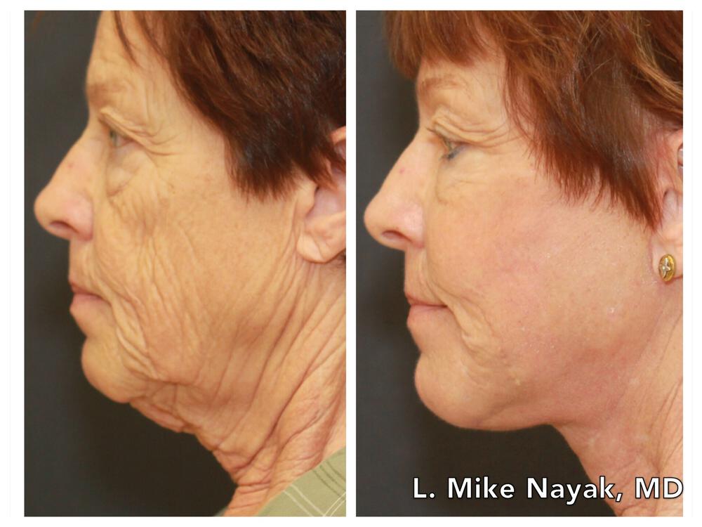 Facelift and Neck Before & After Image