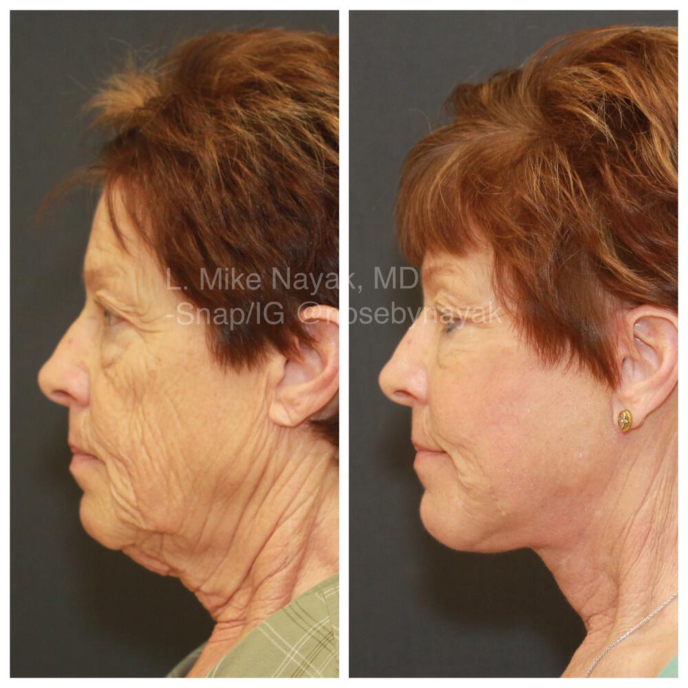 Facelift and Neck Before & After Image