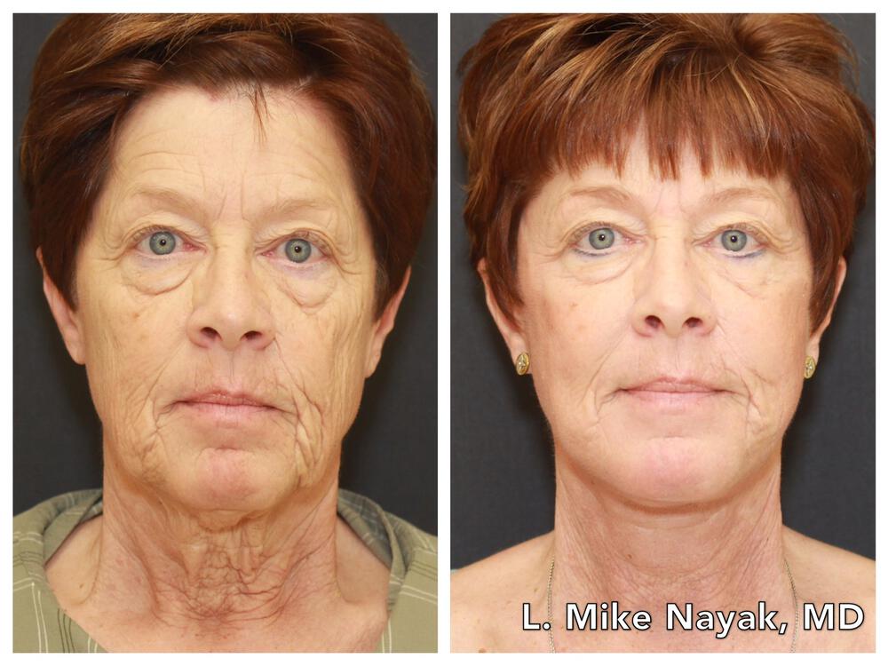 Facelift and Neck Before & After Image