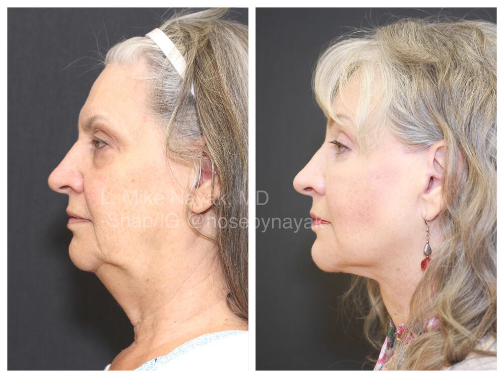 Facelift and Neck Before & After Image