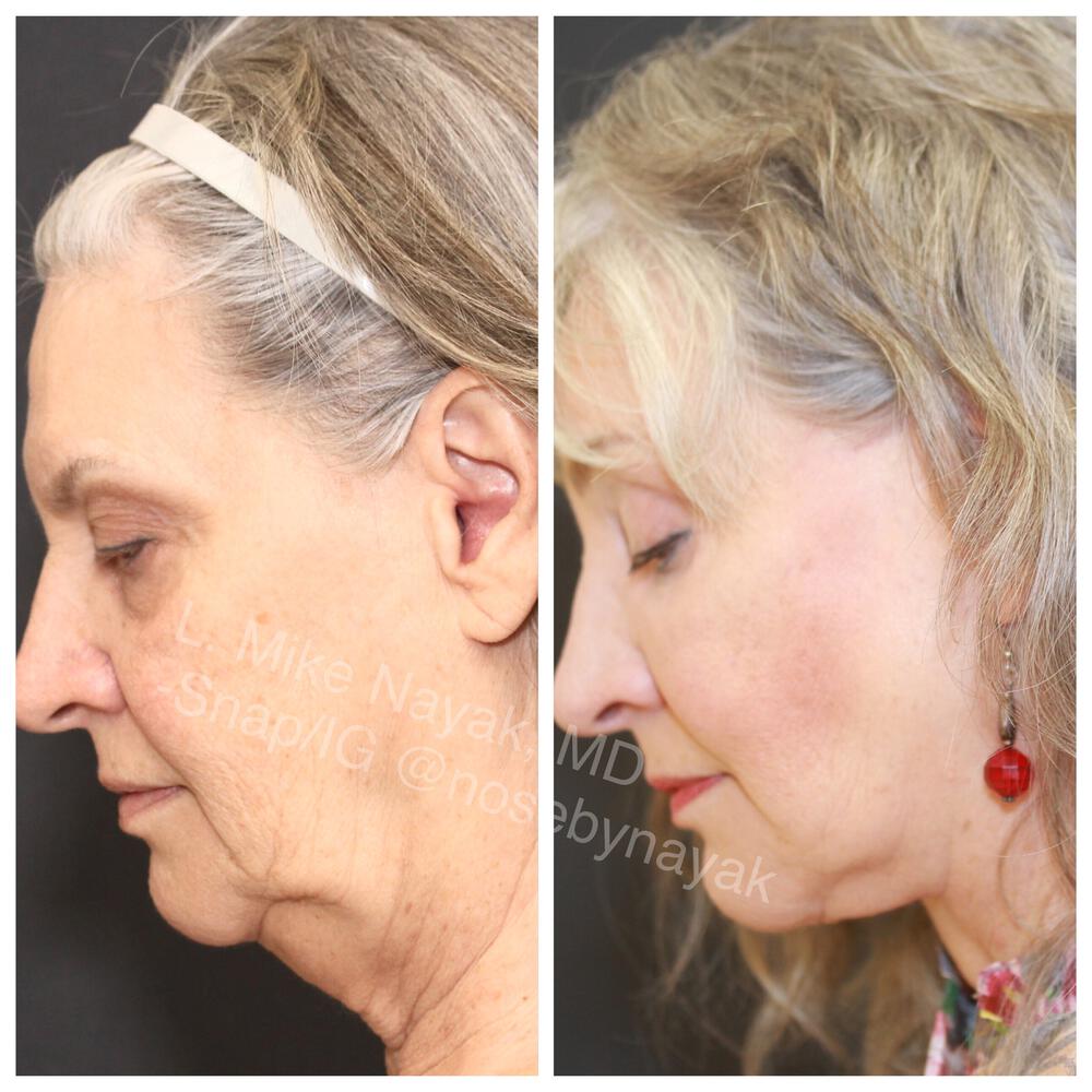 Facelift and Neck Before & After Image