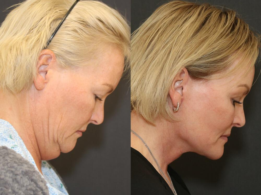 Facelift and Neck Before & After Image