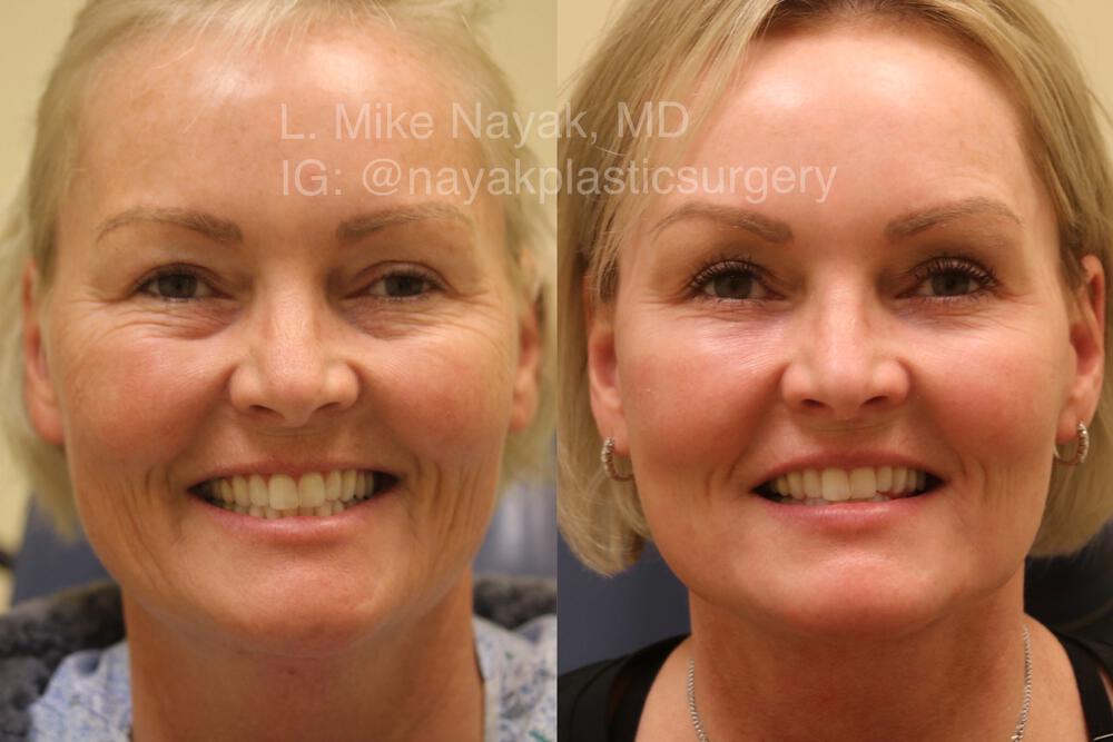 Facelift and Neck Before & After Image