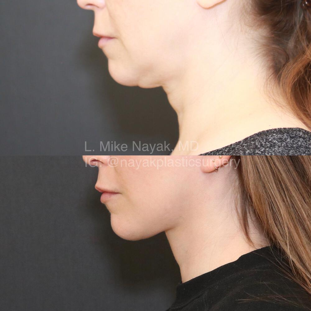 Facelift and Neck Before & After Image