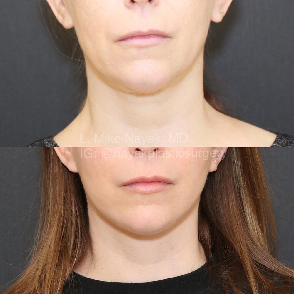 Facelift and Neck Before & After Image