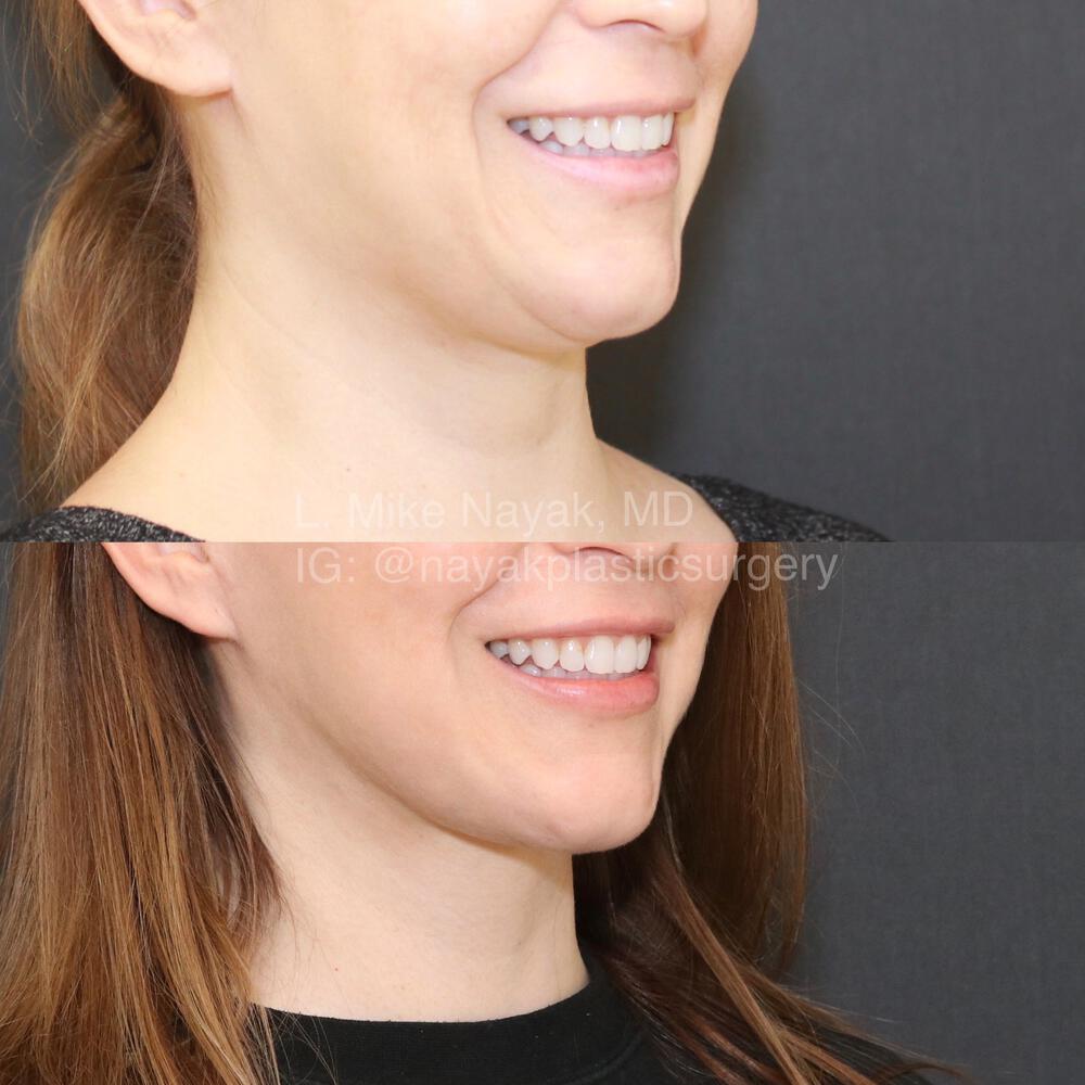 Facelift and Neck Before & After Image