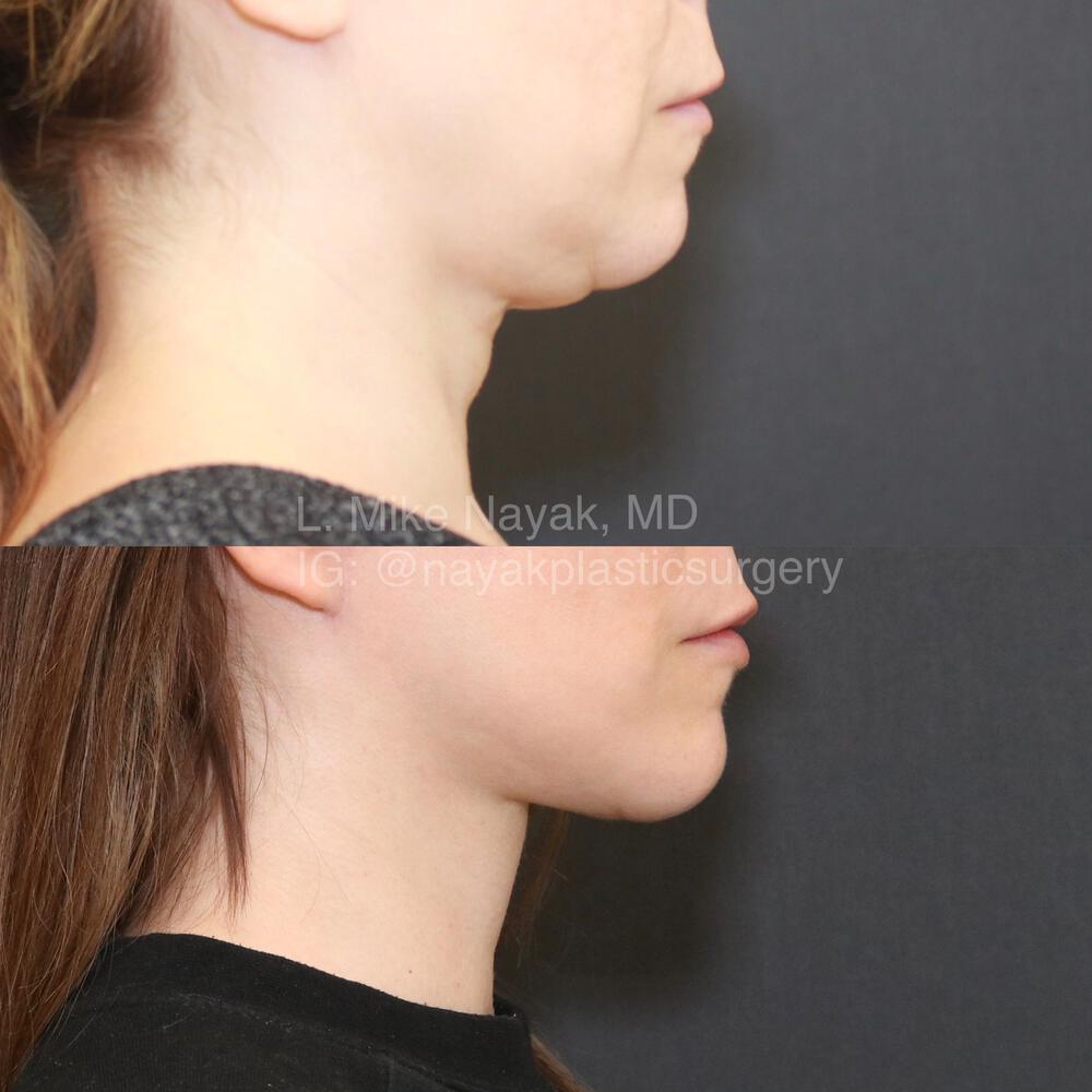 Facelift and Neck Before & After Image