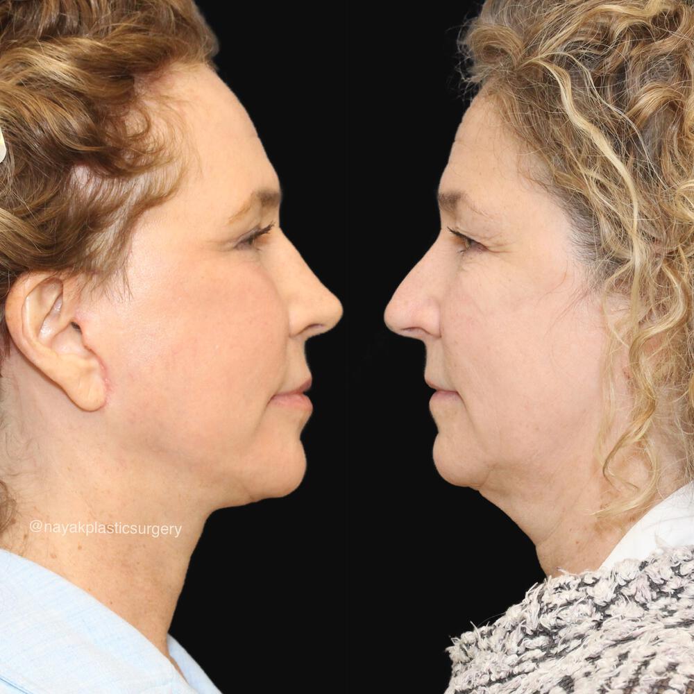 Facelift and Neck Before & After Image