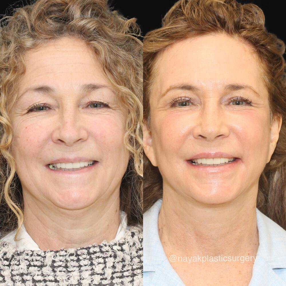 Facelift and Neck Before & After Image