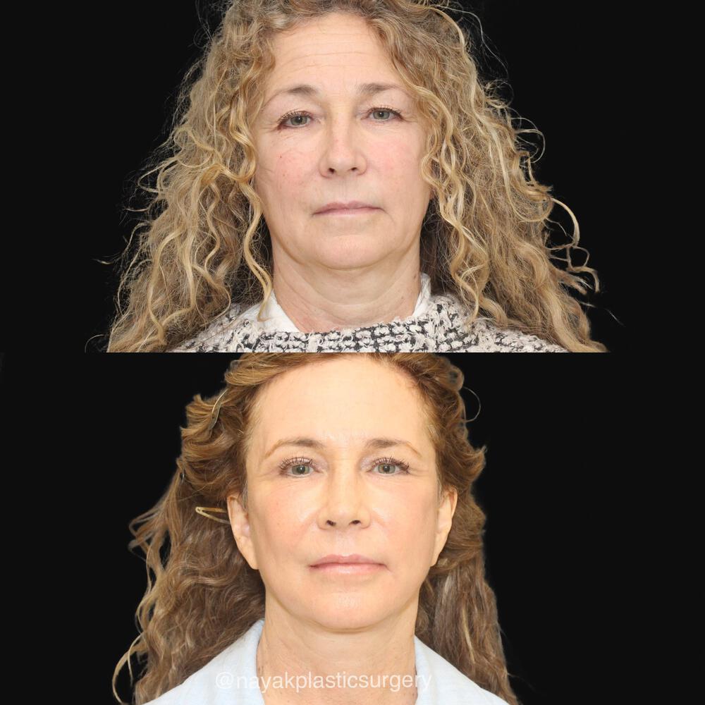 Facelift and Neck Before & After Image