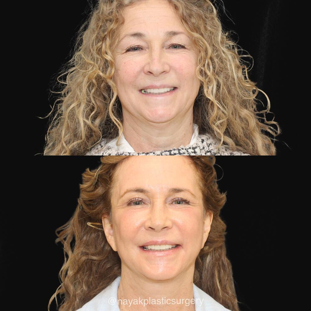 Facelift and Neck Before & After Image