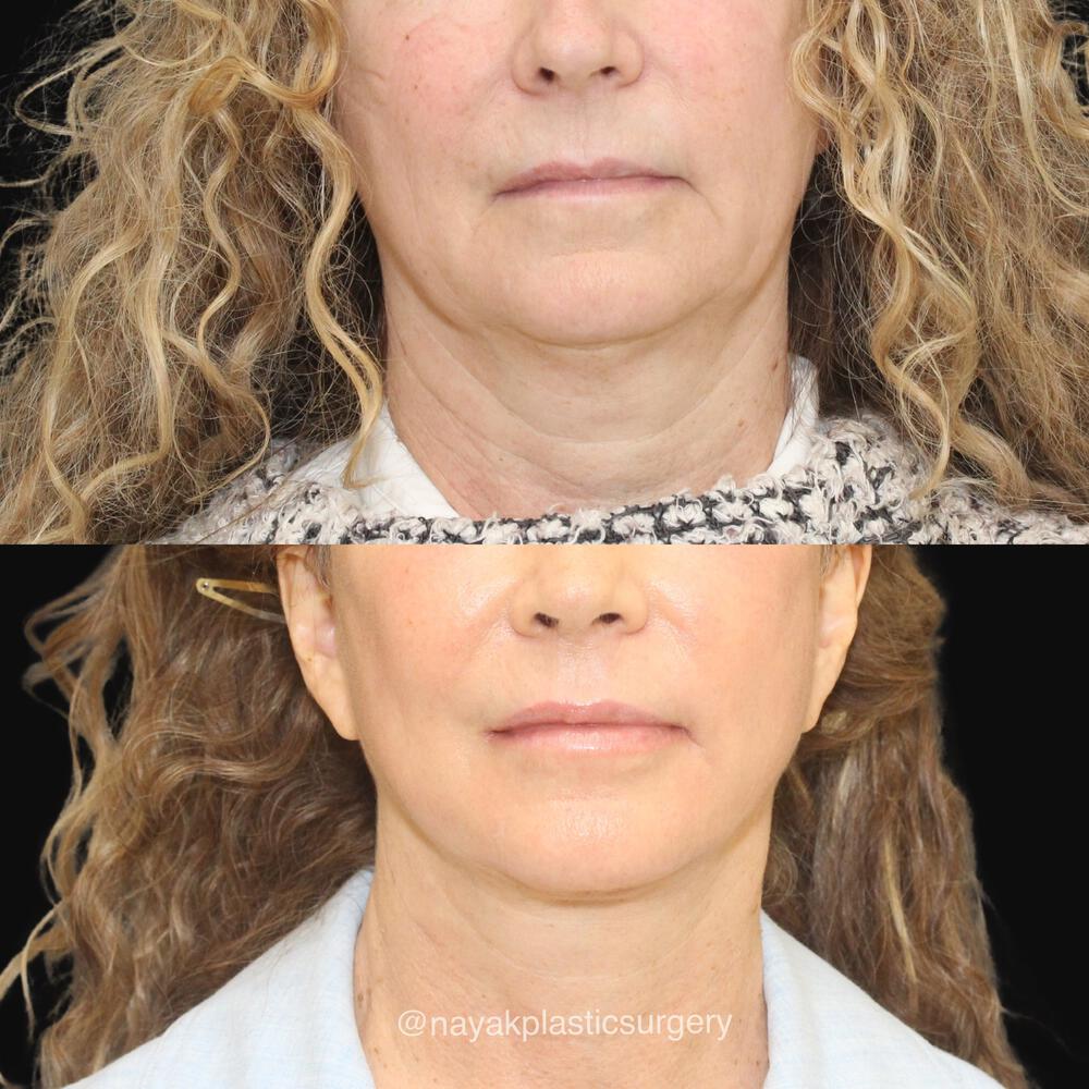 Facelift and Neck Before & After Image