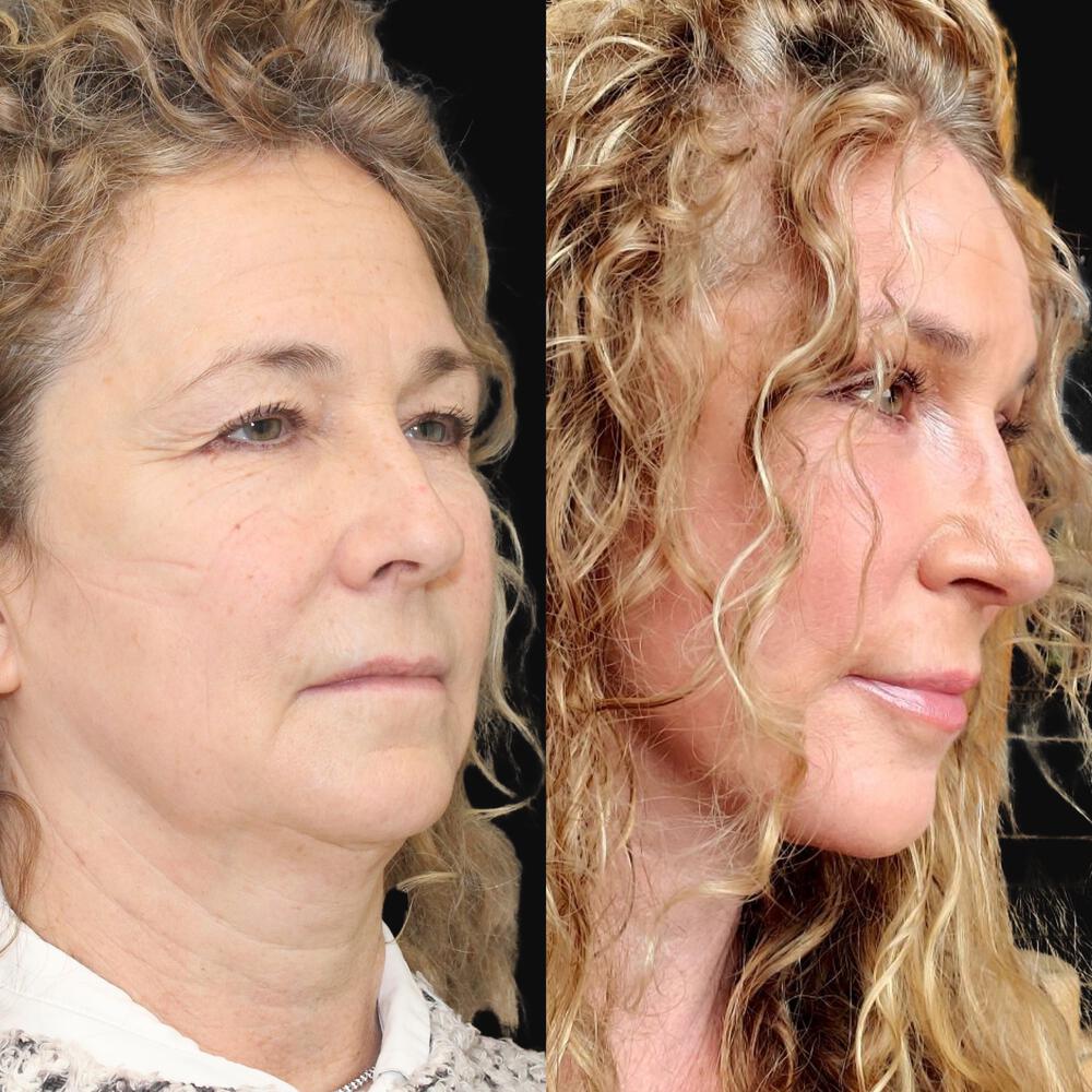 Facelift and Neck Before & After Image