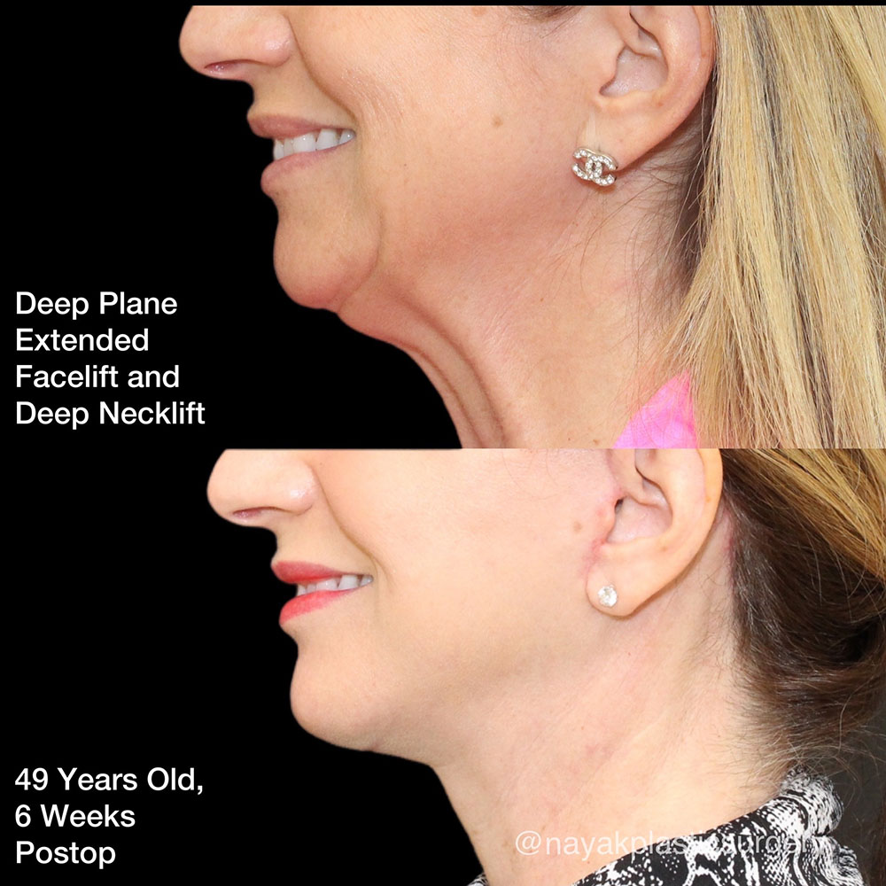 Facelift and Neck Before & After Image