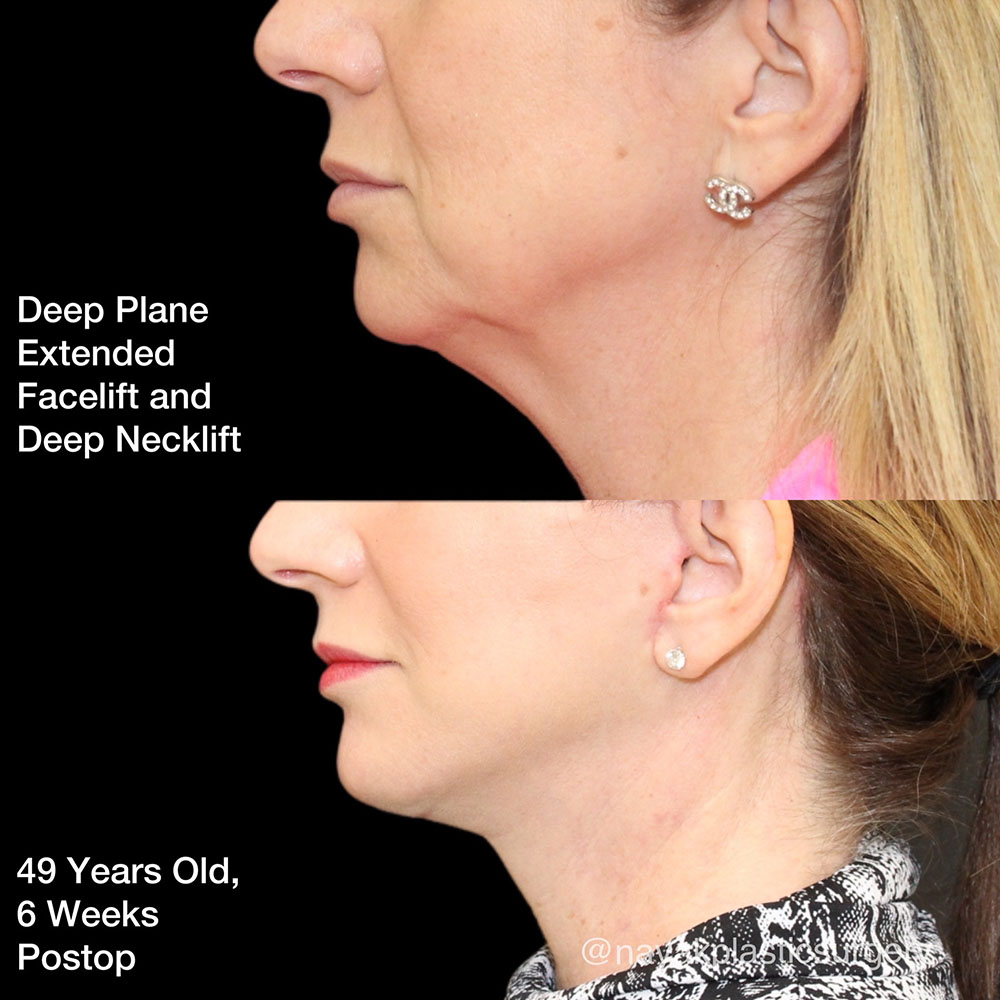 Facelift and Neck Before & After Image